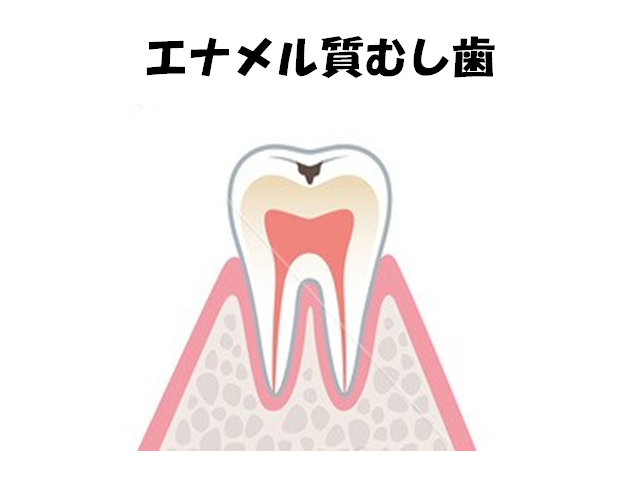 イラスト:エナメル質むし歯