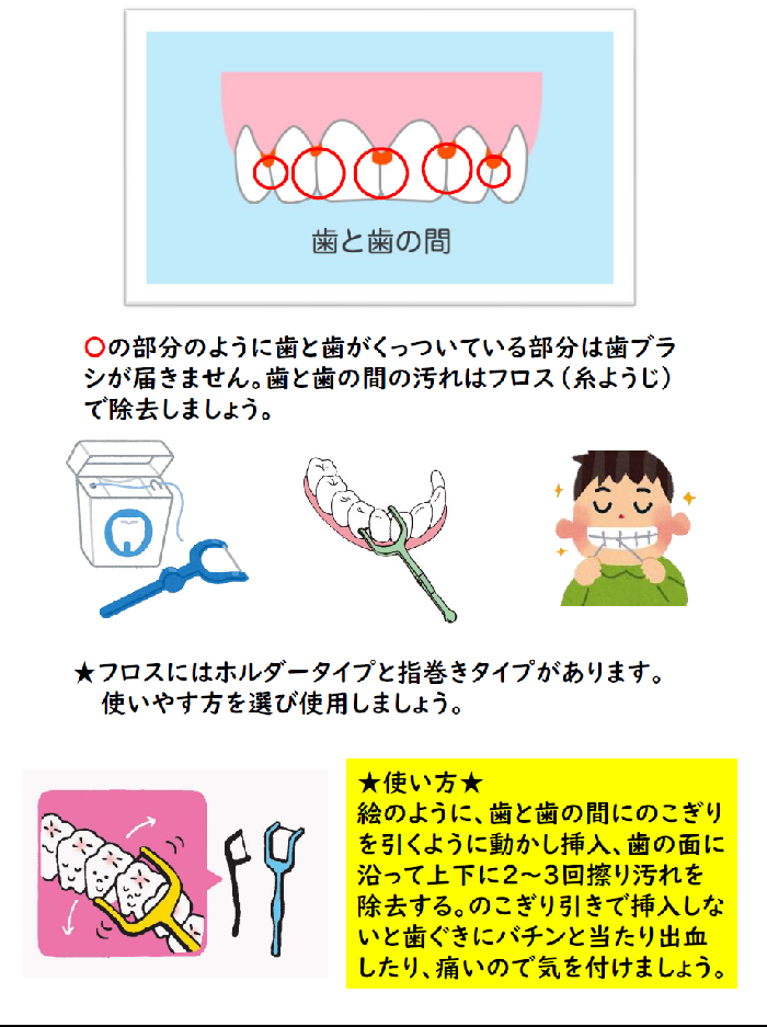 イラスト:歯と歯の間のみがき残しにはフロス