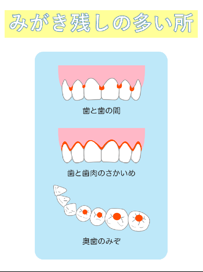 イラスト:みがき残しの多い所