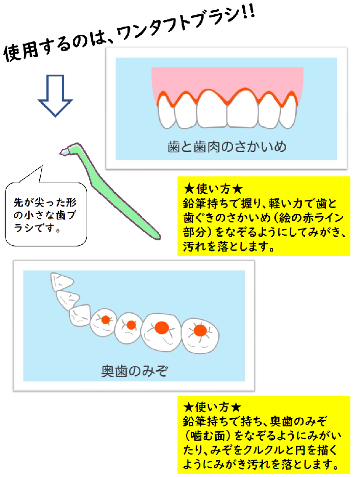 イラスト:歯と歯ぐきの境目、奥歯の深いみぞや奥歯の奥にはワンタフトブラシ