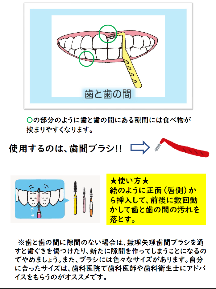 イラスト:歯と歯の間のすき間には、歯間ブラシ