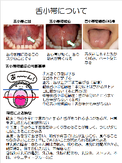 写真：舌小帯について　チラシ