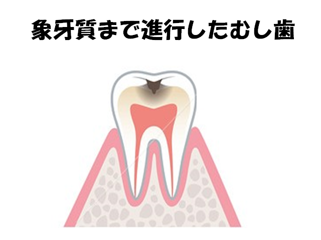 象牙質まで進行したむし歯