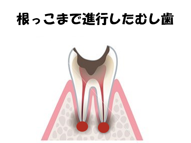 根っこまで進行したむし歯