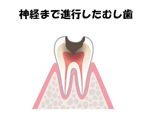 神経まで進行したむし歯